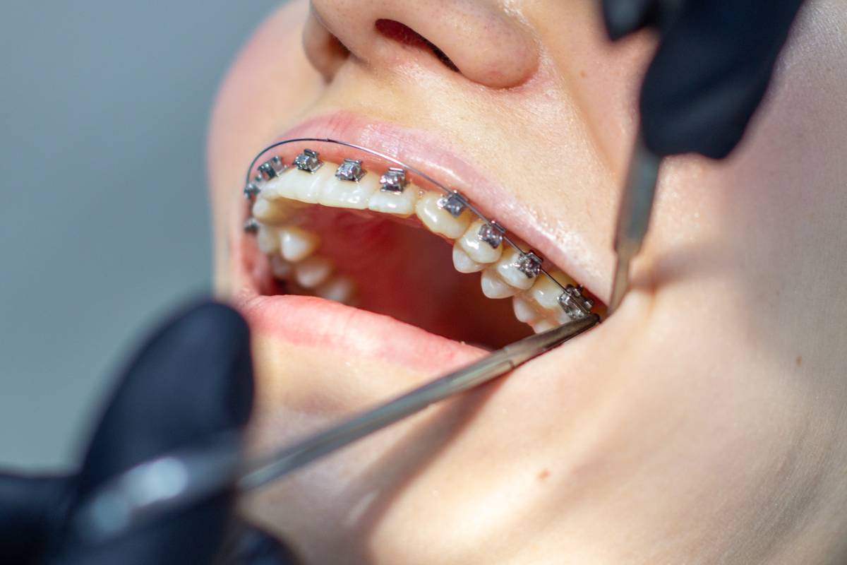 A woman at a dentist's appointment to replace arches with braces.